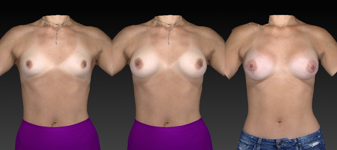 3D Animation of before and after breast augmentation