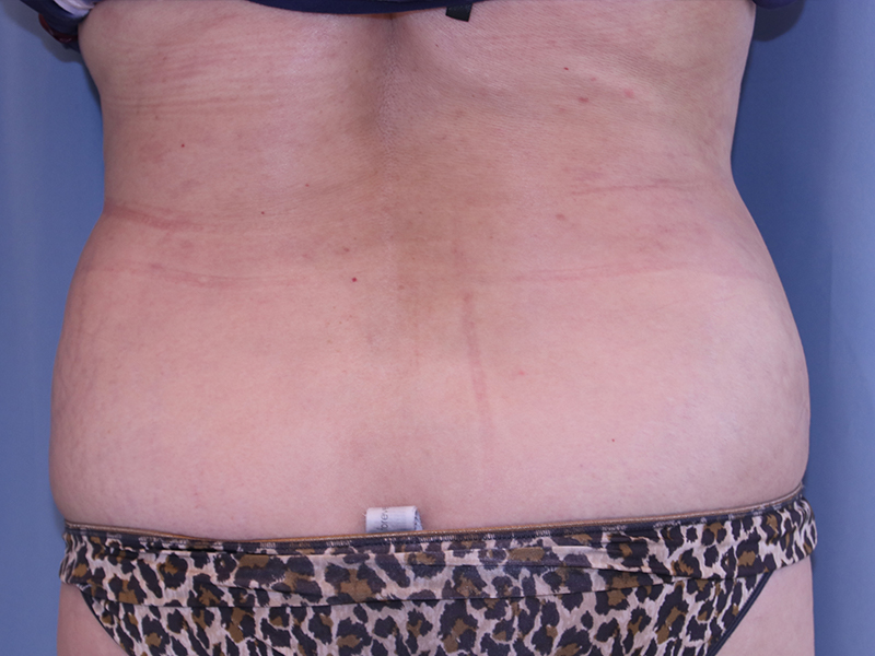 Liposuction Before and After 22