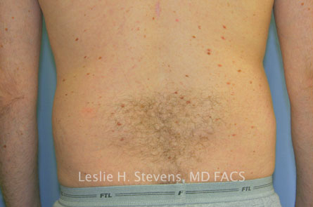 Liposuction Before and After | Dr. Leslie Stevens