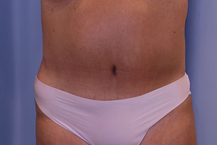 Tummy Tuck Before and After 14