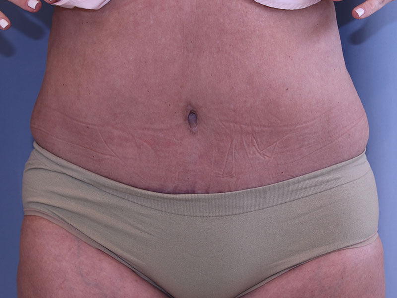 Tummy Tuck Before and After 34