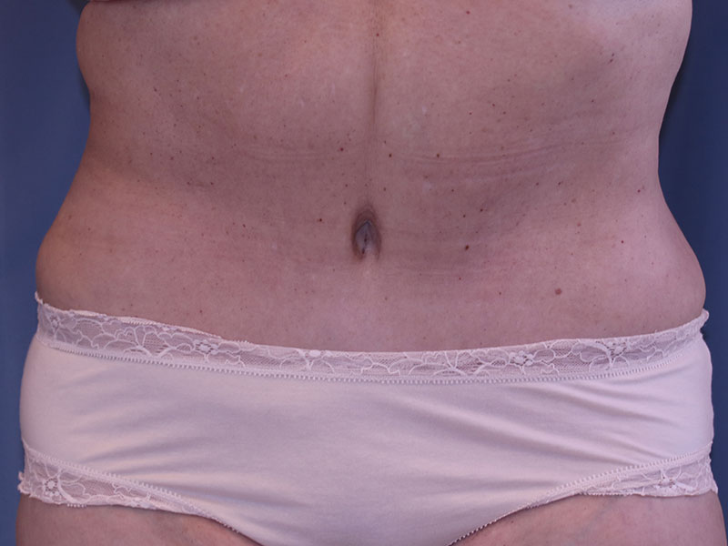 Tummy Tuck Before and After 28
