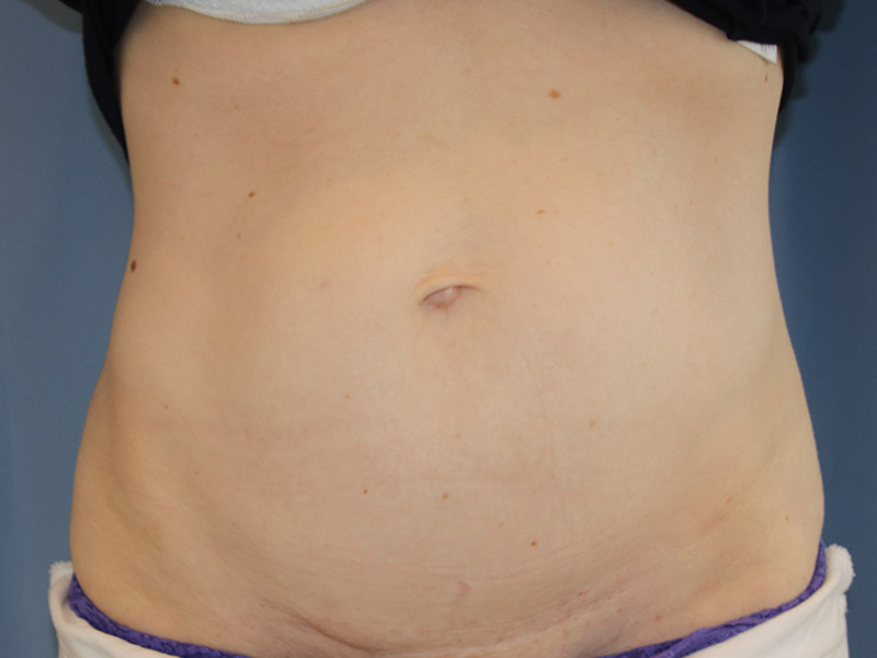 Tummy Tuck Before and After 09