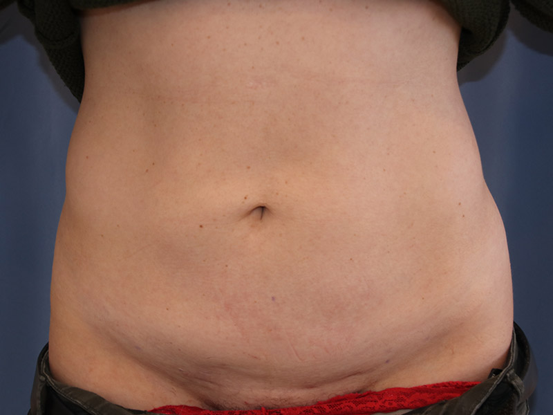 Tummy Tuck Before and After 11