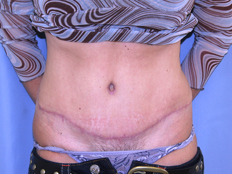 Tummy Tuck Before and After 08