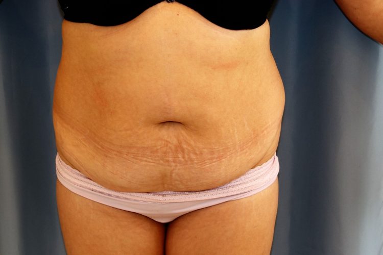 Tummy Tuck Before and After 19