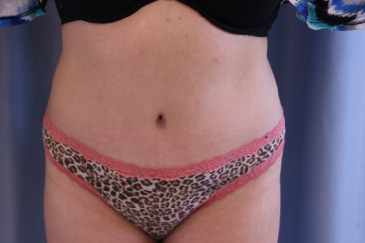 Tummy Tuck Before and After 22