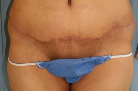 Tummy Tuck Before and After 10