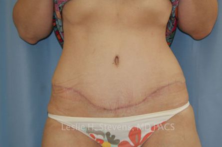 Tummy Tuck Before and After 30