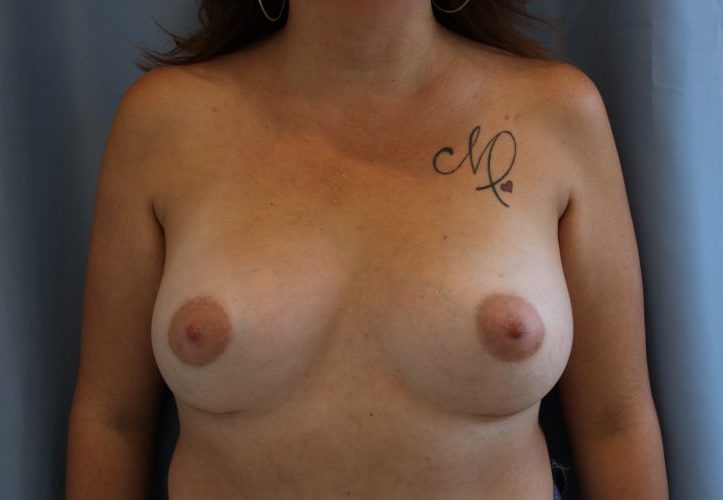 Breast Augmentation Before and After 47
