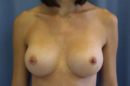 Breast Augmentation Before and After 55