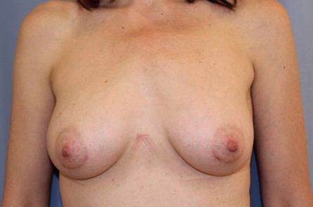 Breast Augmentation Before and After 05