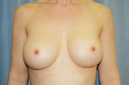 Breast Augmentation Before and After 01