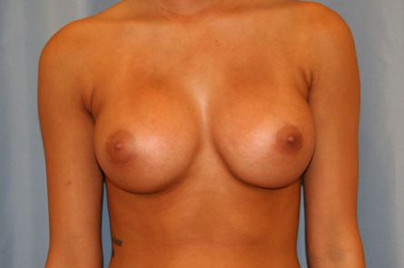 Breast Augmentation Before and After 11