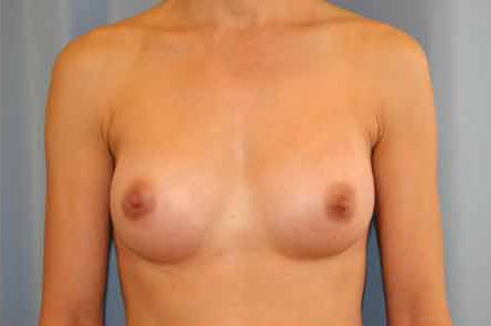 Breast Augmentation Before and After 50
