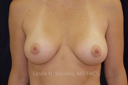 Breast Augmentation Before and After 56