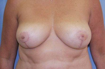 Breast Reduction Before and After 06