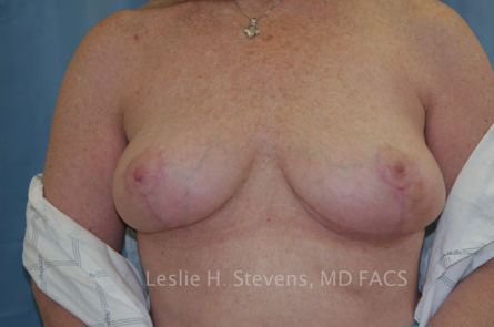 Breast Reduction Before and After 14