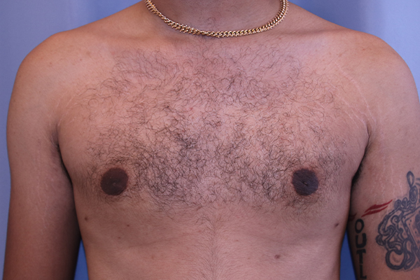Gynecomastia Before and After 03