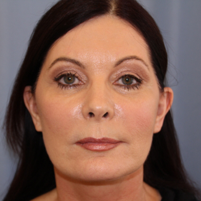 Facelift Before and After 26