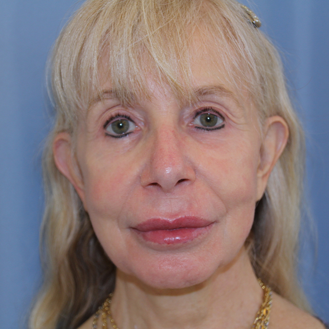 Facelift Before and After | Dr. Leslie Stevens