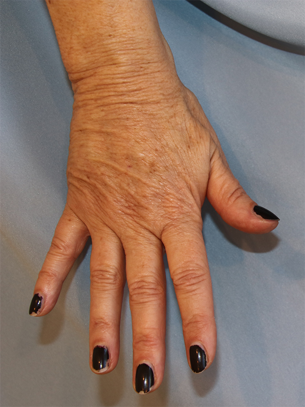Hand Rejuvenation Before and After | Dr. Leslie Stevens