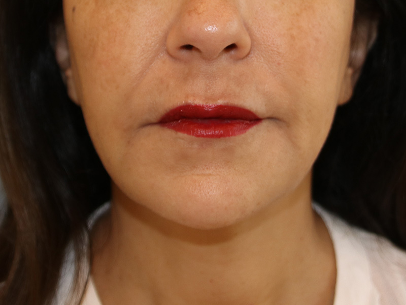 Juvederm Before and After 01