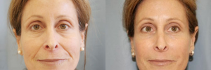 JUVEDERM Before and After