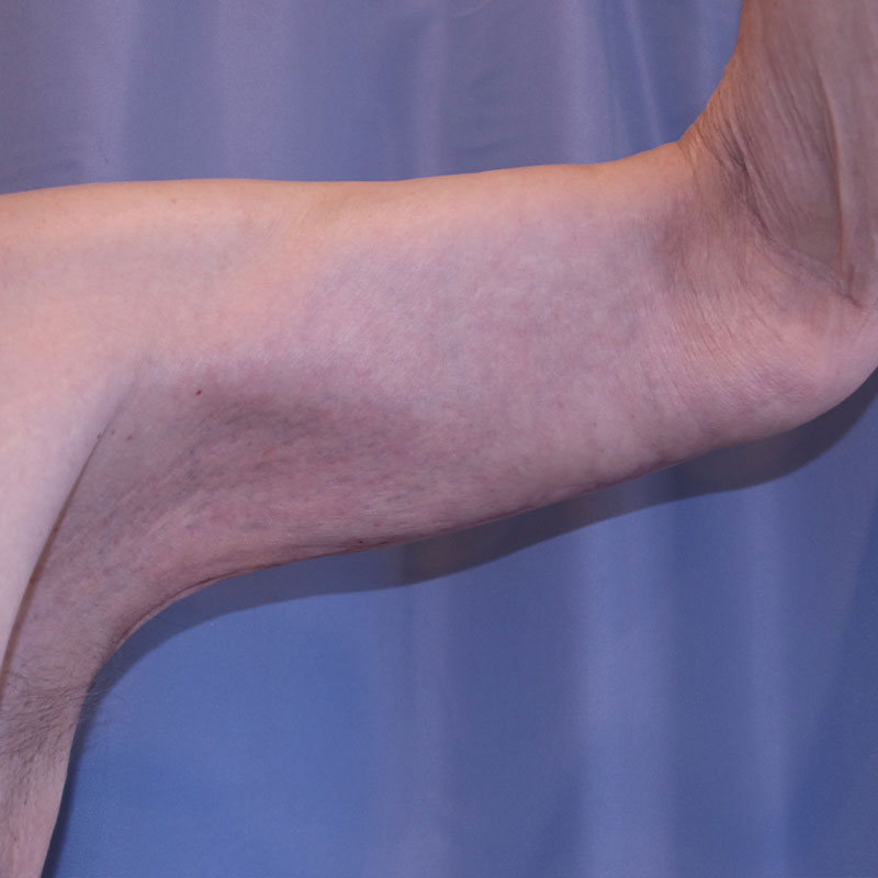 Arm Lift Before and After | Dr. Leslie Stevens