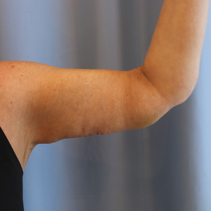 Arm Lift Before and After | Dr. Leslie Stevens