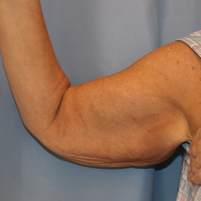 Arm Lift Before and After | Dr. Leslie Stevens