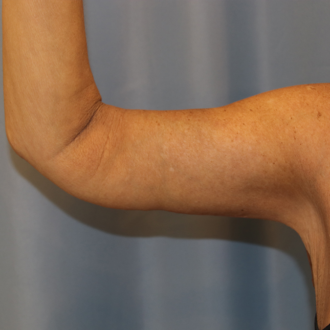 Arm Lift Before and After | Dr. Leslie Stevens