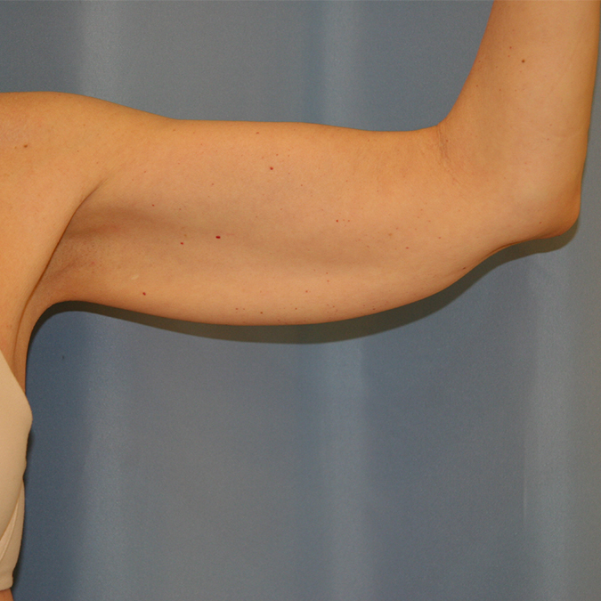 Arm Lift Before and After | Dr. Leslie Stevens