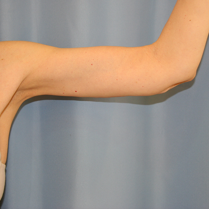 Arm Lift Before and After | Dr. Leslie Stevens