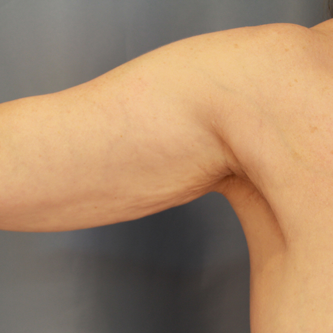 Arm Lift Before and After | Dr. Leslie Stevens