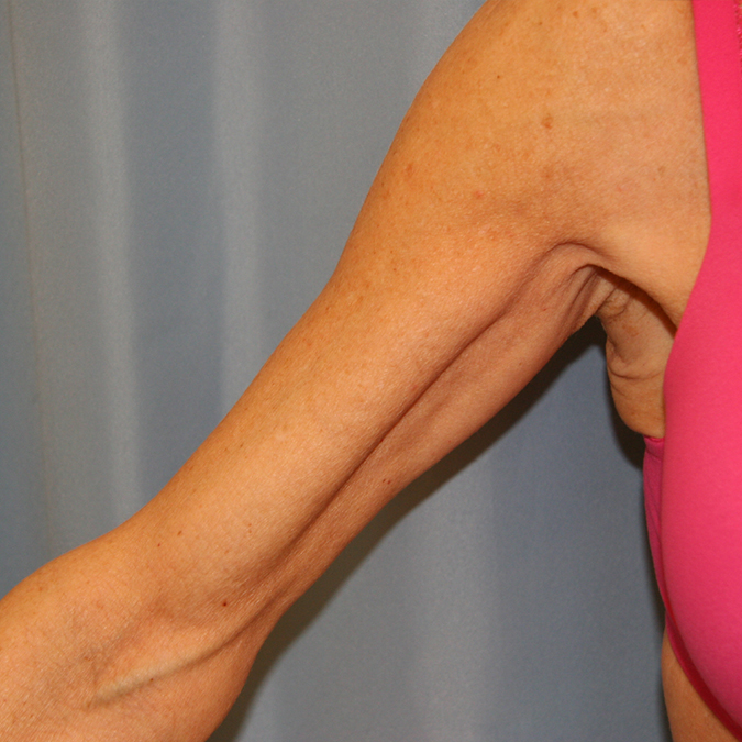 Arm Lift Before and After | Dr. Leslie Stevens