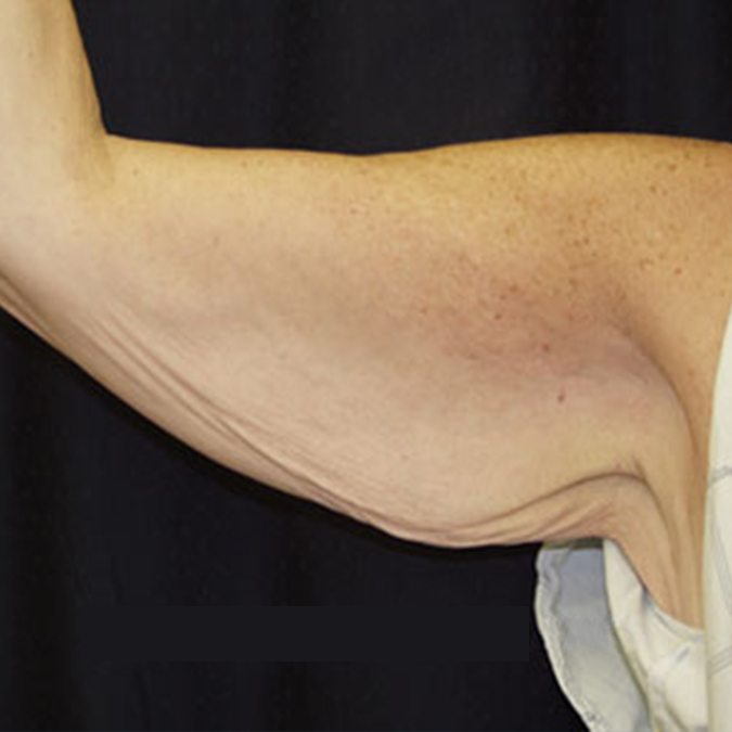 Arm Lift Before and After | Dr. Leslie Stevens