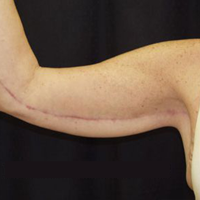 Arm Lift Before and After | Dr. Leslie Stevens