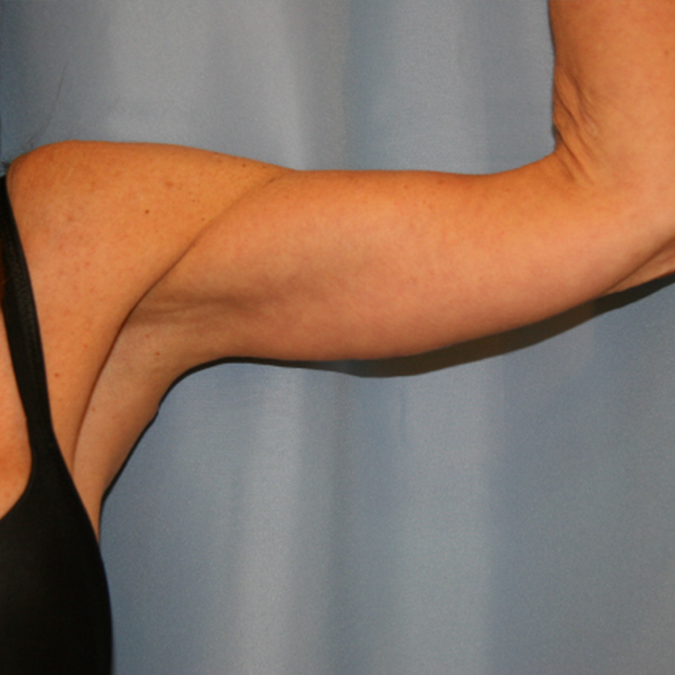 Arm Lift Before and After | Dr. Leslie Stevens