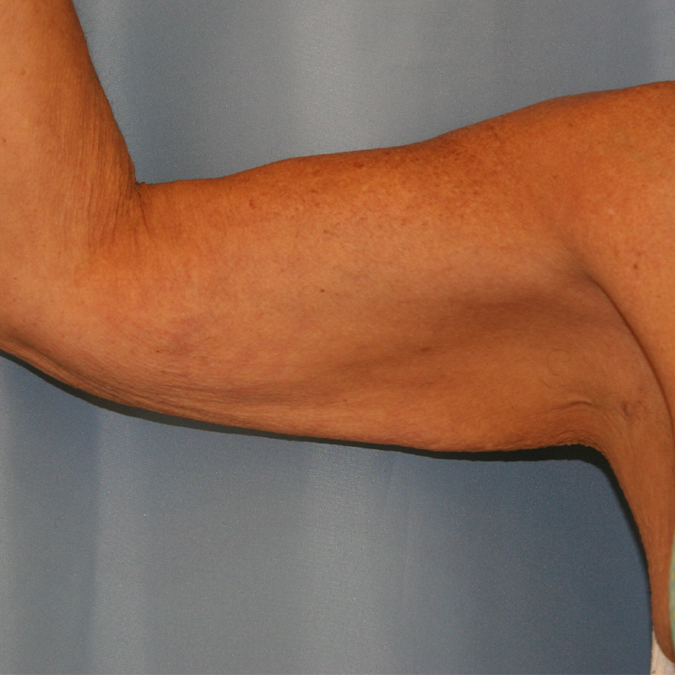 Arm Lift Before and After | Dr. Leslie Stevens