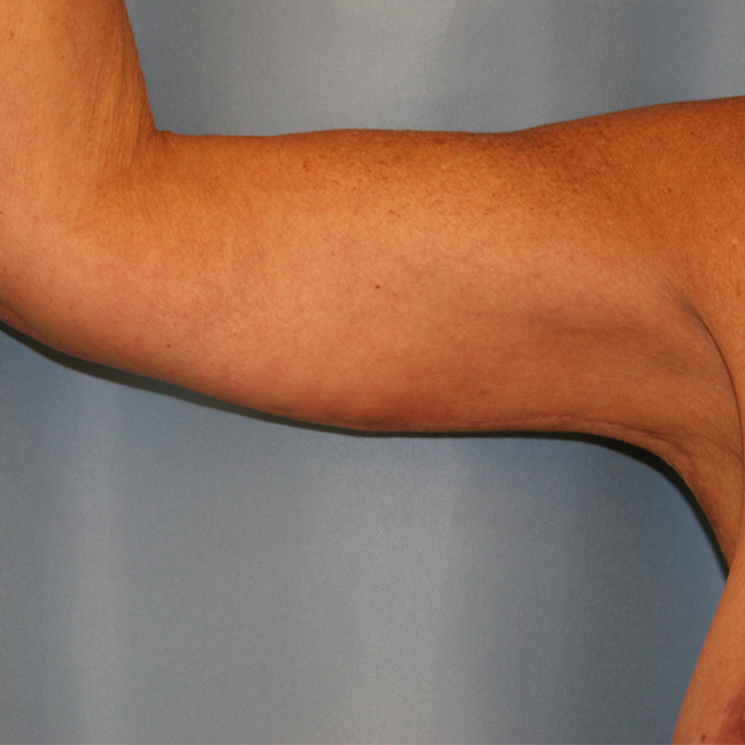 Arm Lift Before and After | Dr. Leslie Stevens