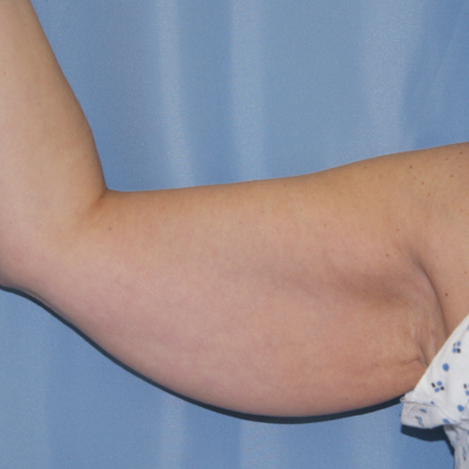 Arm Lift Before and After | Dr. Leslie Stevens