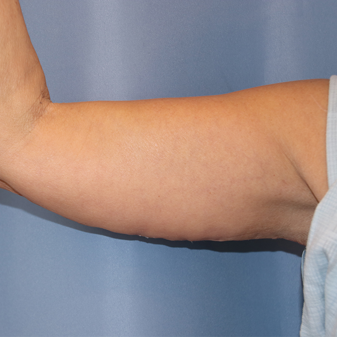 Arm Lift Before and After | Dr. Leslie Stevens