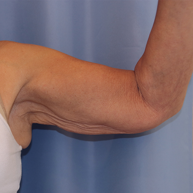 Arm Lift Before and After | Dr. Leslie Stevens