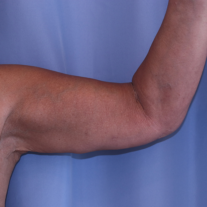 Arm Lift Before and After | Dr. Leslie Stevens