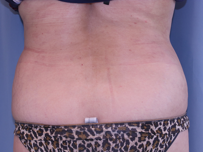 Liposuction Before and After | Dr. Leslie Stevens