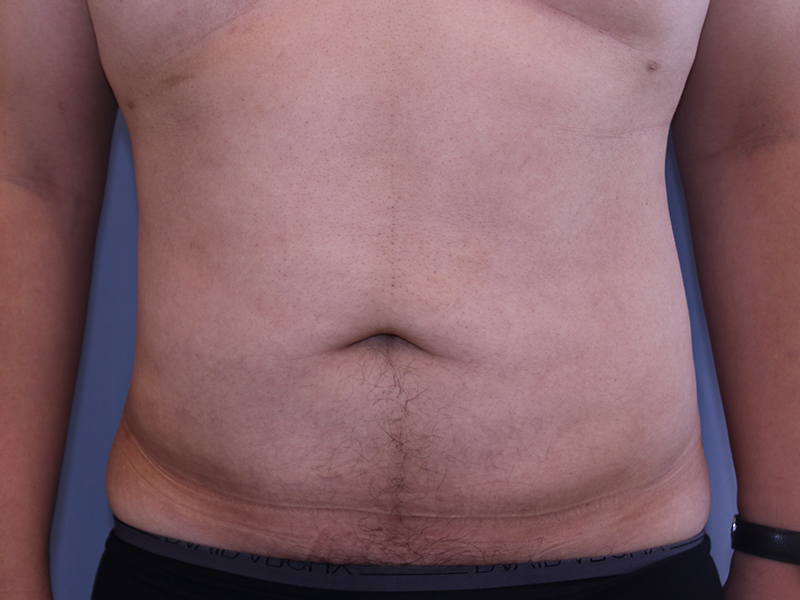 Liposuction Before and After 20