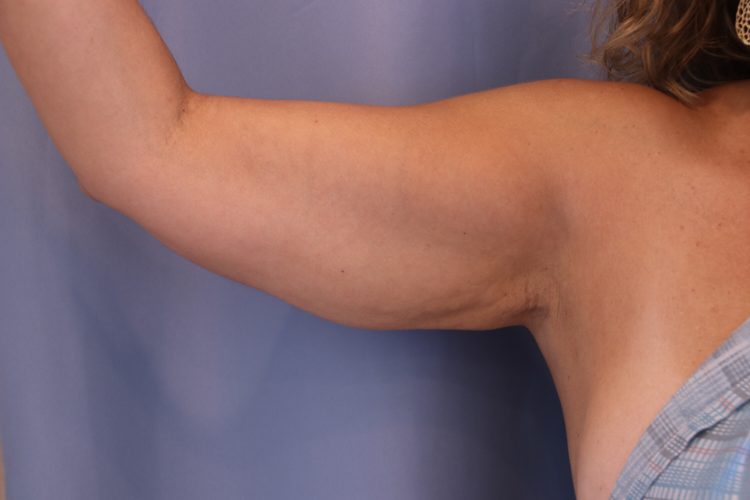 Liposuction Before and After | Dr. Leslie Stevens