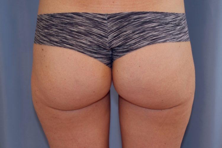 Liposuction Before and After | Dr. Leslie Stevens