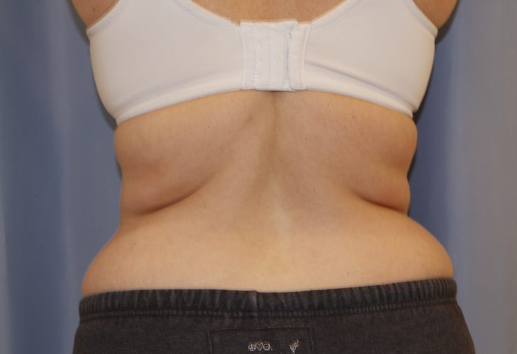 Liposuction Before and After 10